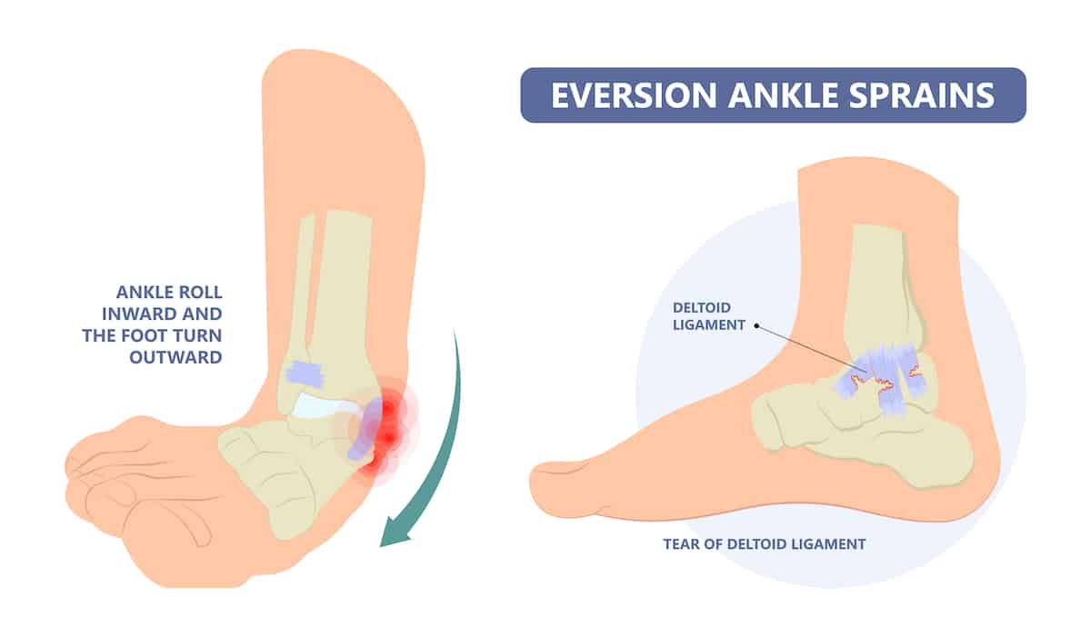 medial ankle sprain